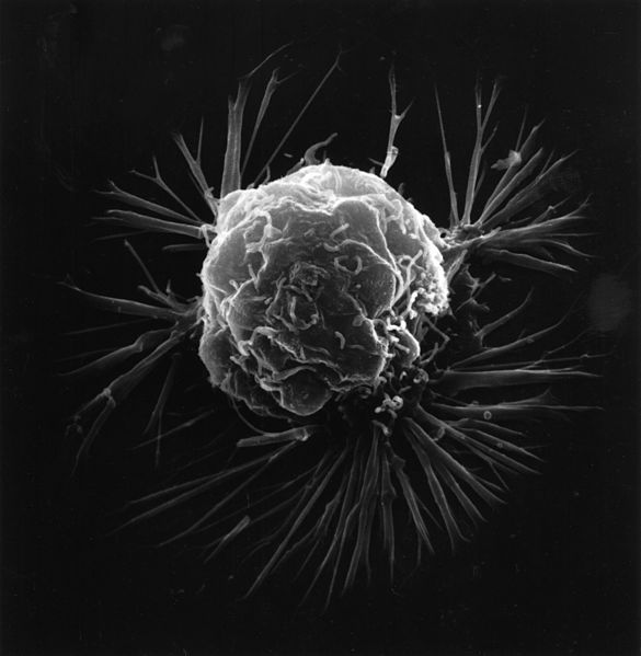 Una célula de cáncer de mama, fotografiada por un microscopio electrónico de barrido, que produce imágenes tridimensionales. Foto; Unknown photographer/Public domain, via Wikimedia Commons.