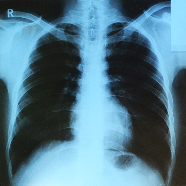 Radiografía de pulmón. Foto: Sudraben/CC BY-SA 4.0, via Wikimedia Commons.